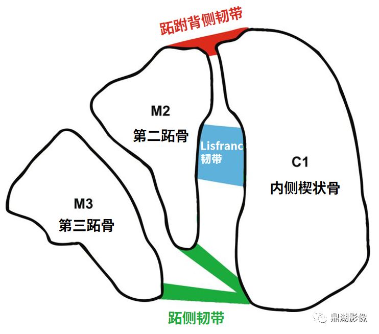 非常容易漏诊的Lisfranc损伤