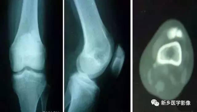 膝关节疼痛，应想到的22种疾病
