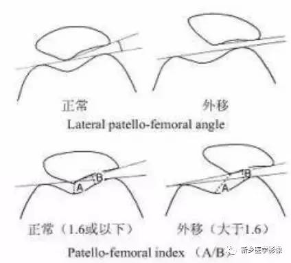 膝关节疼痛，应想到的22种疾病