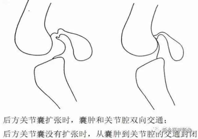 膝关节疼痛，应想到的22种疾病