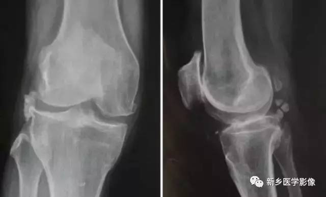 膝关节疼痛，应想到的22种疾病