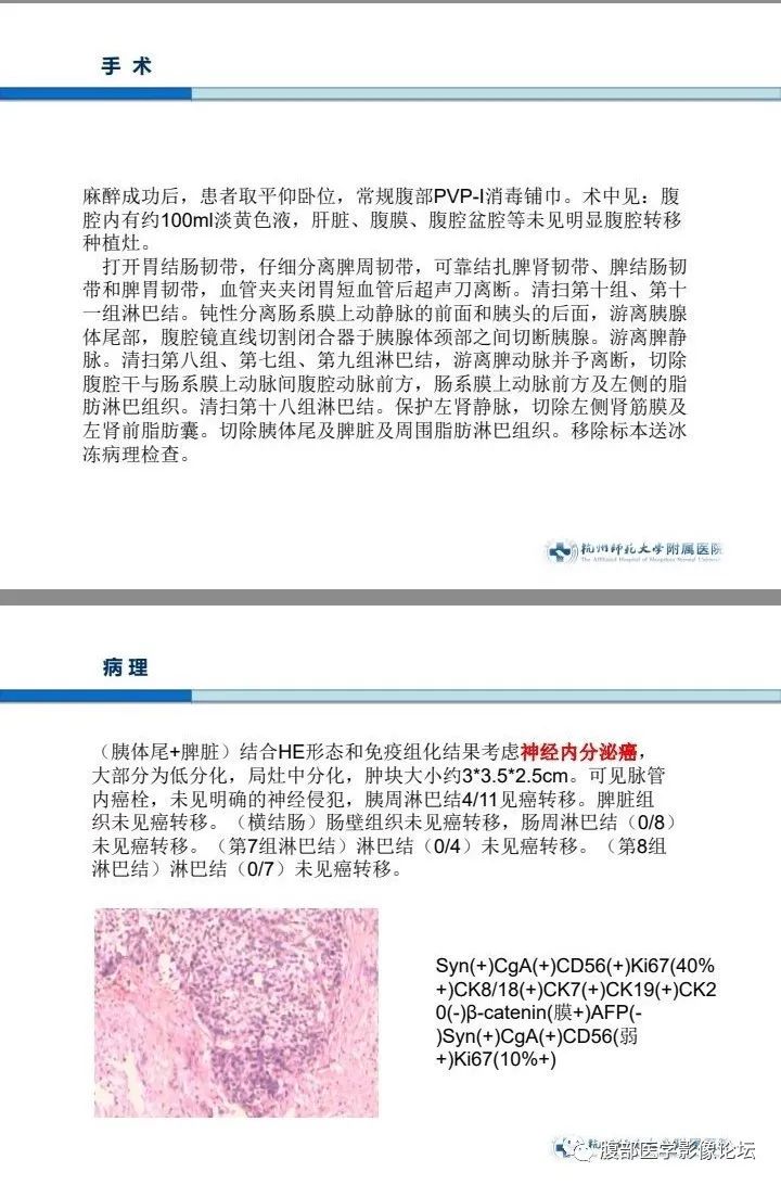 【病例】胰腺神经内分泌癌1例CT影像