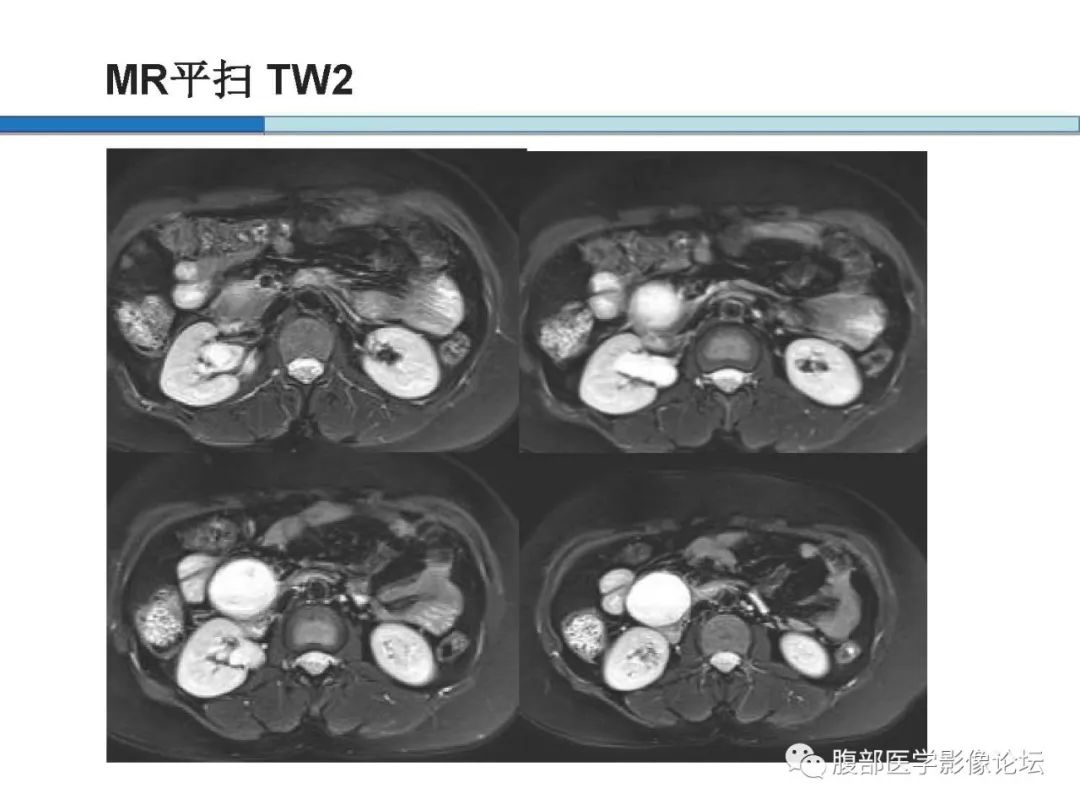 【病例】胰腺实性假乳头状肿瘤1例CT及MR