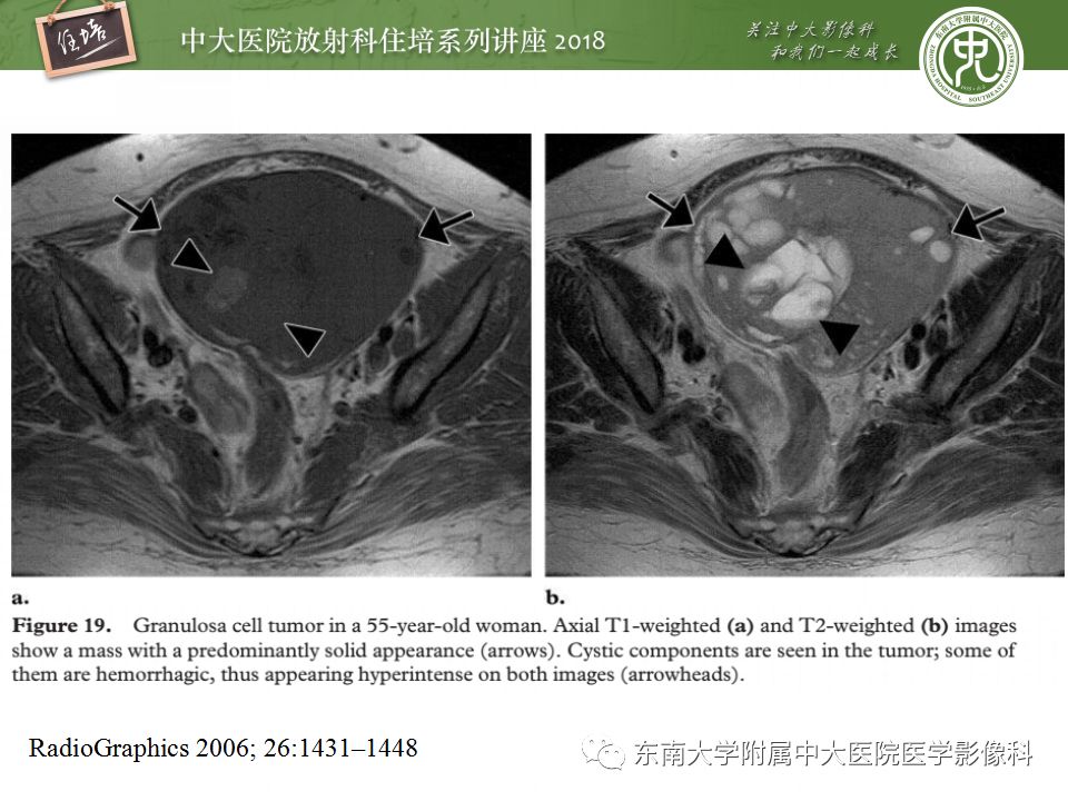 【PPT】卵巢占位诊断与鉴别