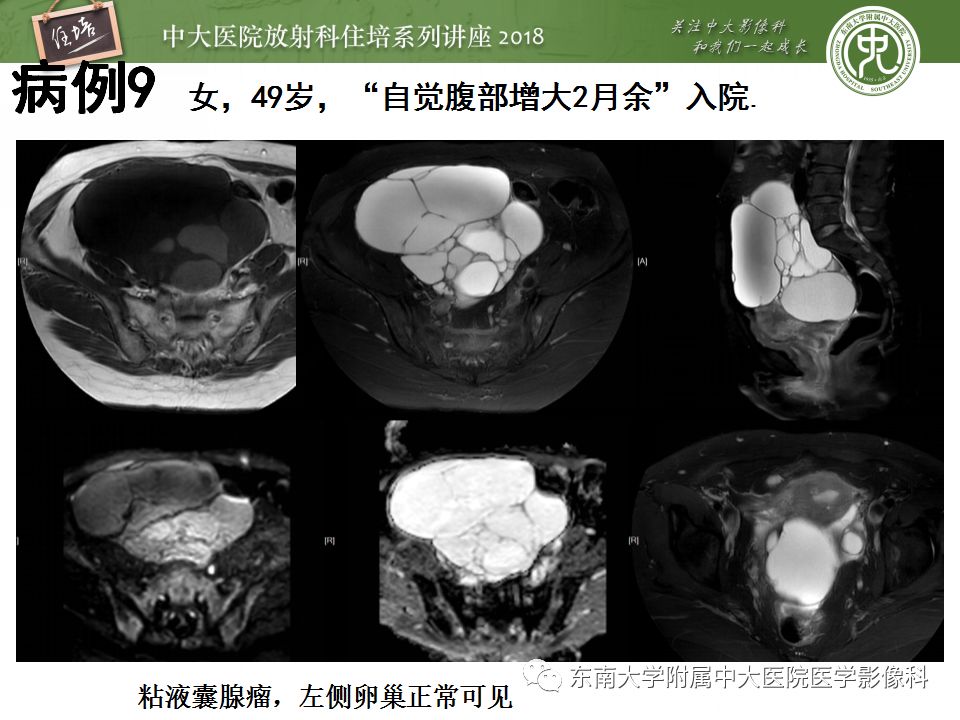 【PPT】卵巢占位诊断与鉴别