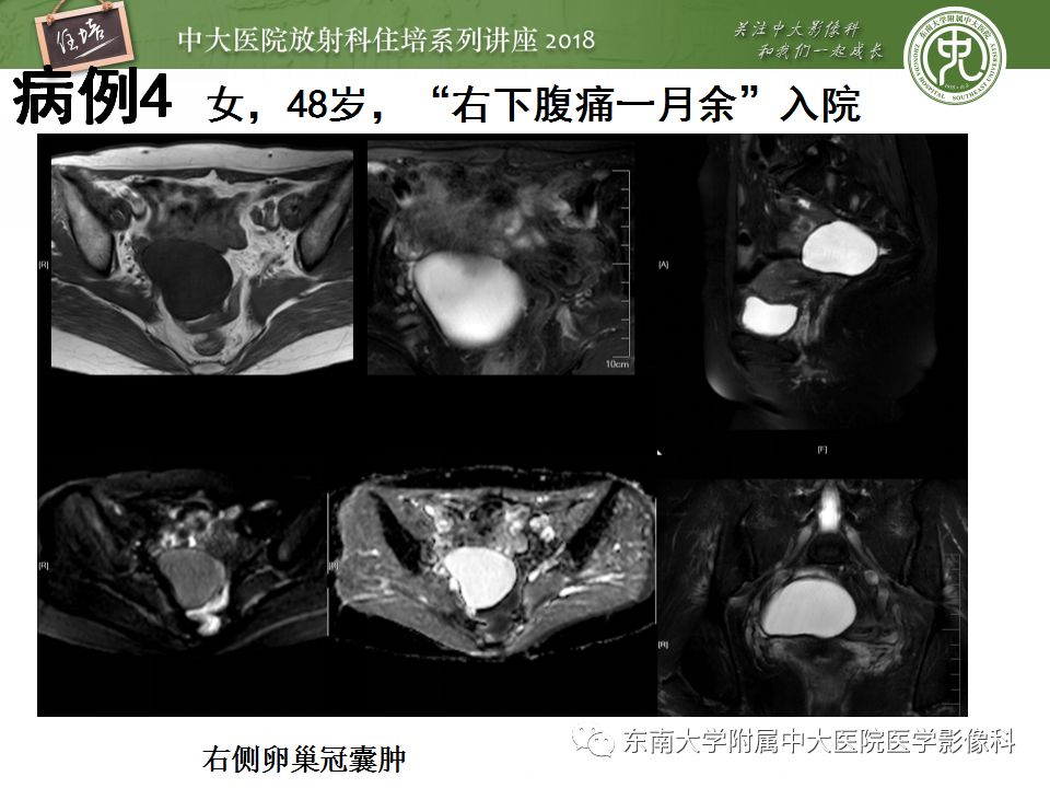 【PPT】卵巢占位诊断与鉴别