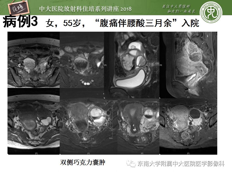 【PPT】卵巢占位诊断与鉴别