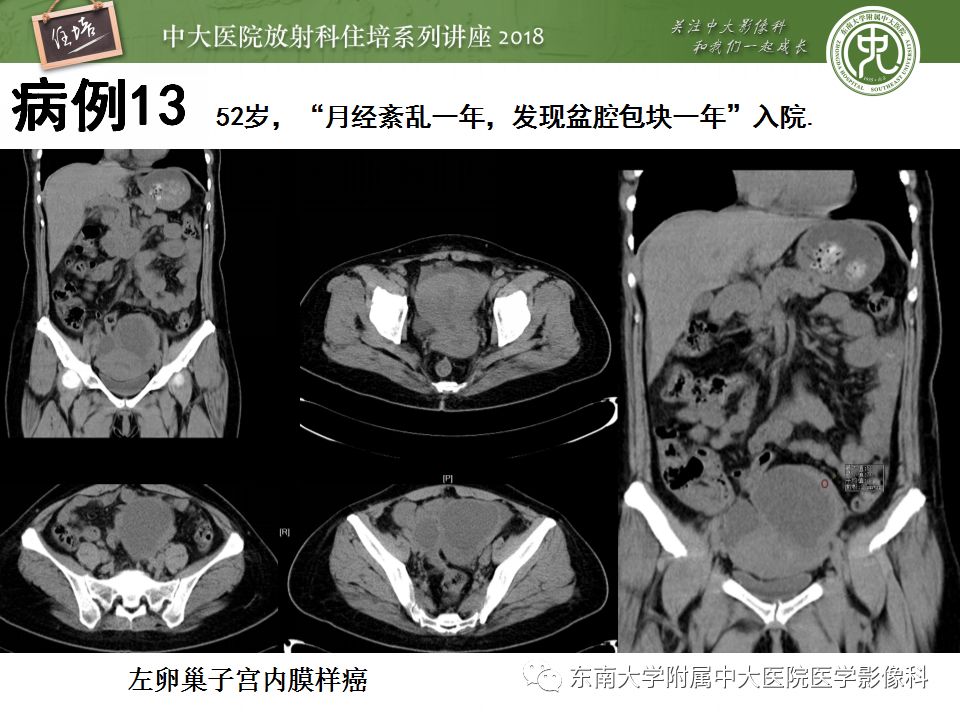 【PPT】卵巢占位诊断与鉴别