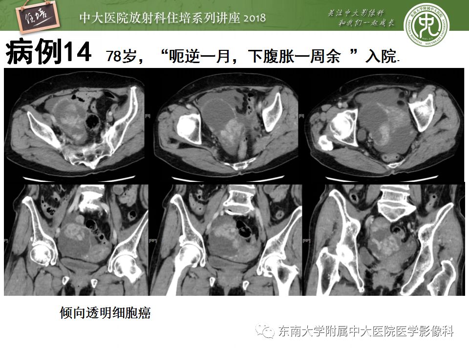【PPT】卵巢占位诊断与鉴别