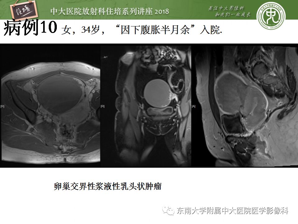 【PPT】卵巢占位诊断与鉴别
