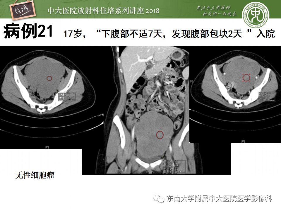 【PPT】卵巢占位诊断与鉴别