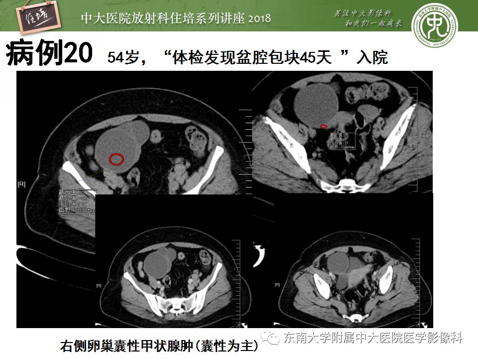 【PPT】卵巢占位诊断与鉴别