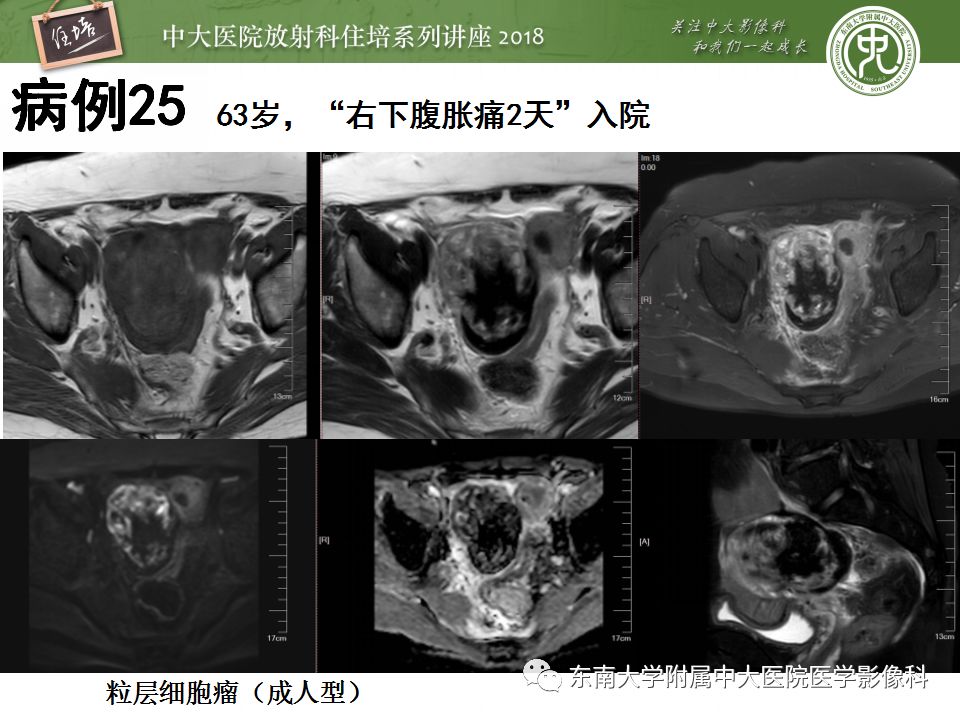 【PPT】卵巢占位诊断与鉴别