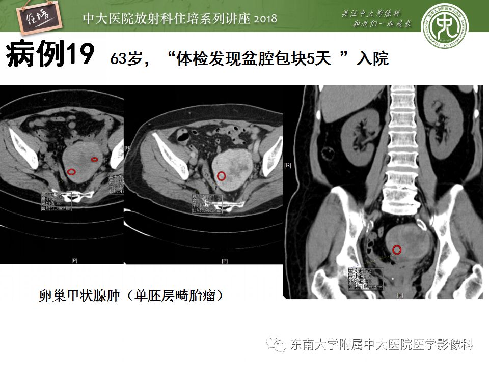 【PPT】卵巢占位诊断与鉴别