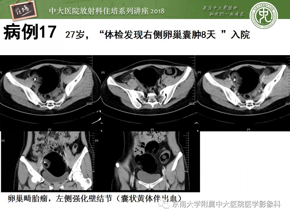 【PPT】卵巢占位诊断与鉴别
