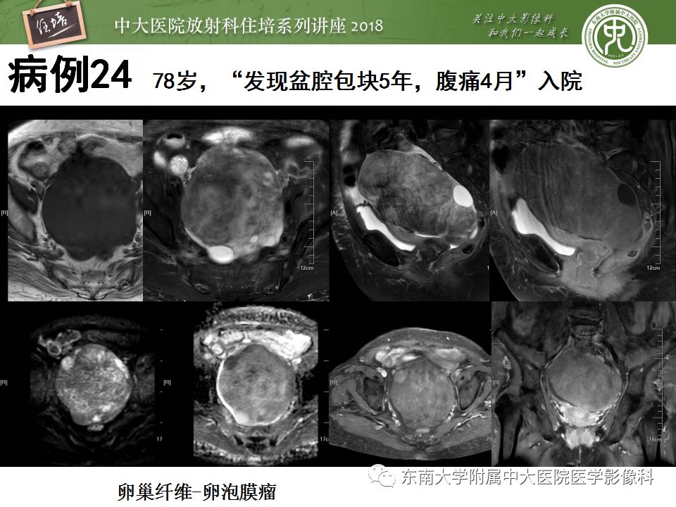 【PPT】卵巢占位诊断与鉴别