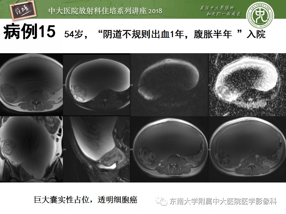 【PPT】卵巢占位诊断与鉴别