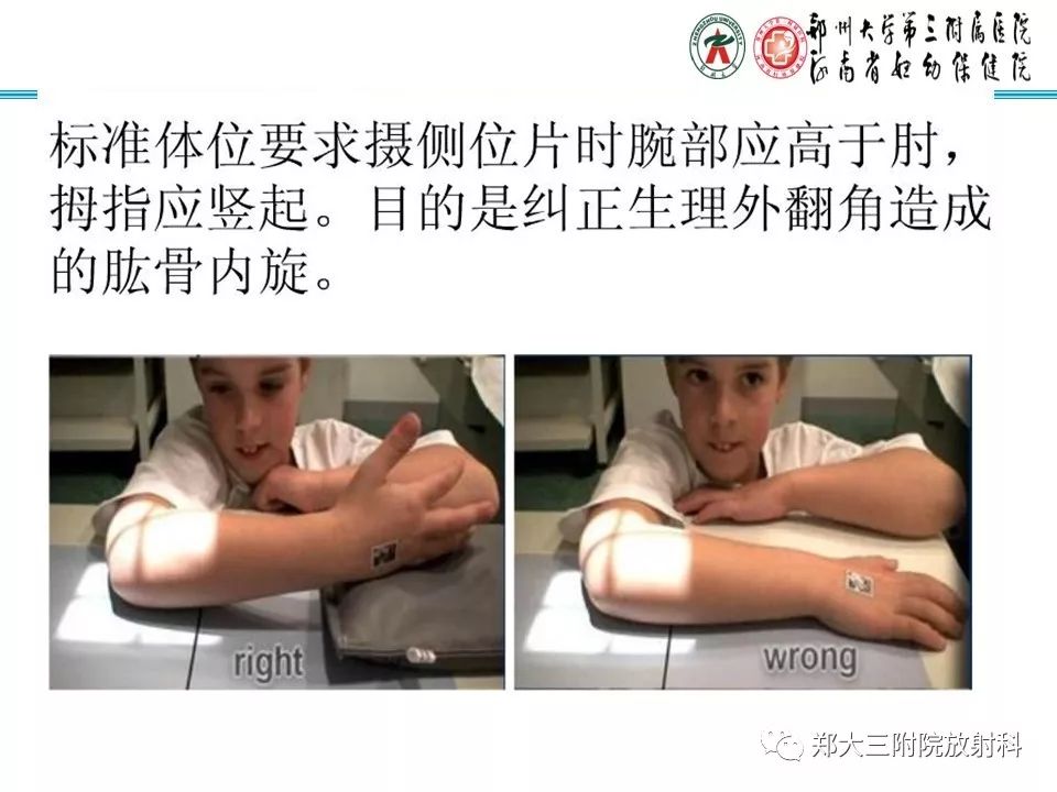 【PPT】儿童肘关节骨折的X线表现