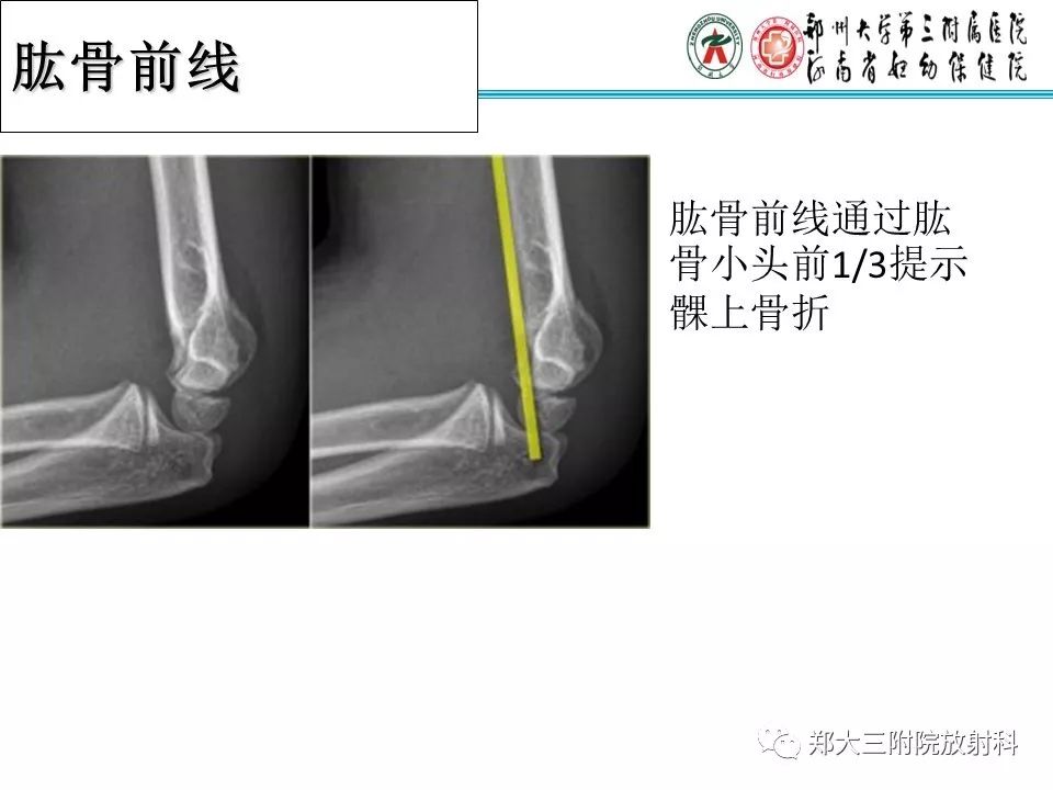 【PPT】儿童肘关节骨折的X线表现