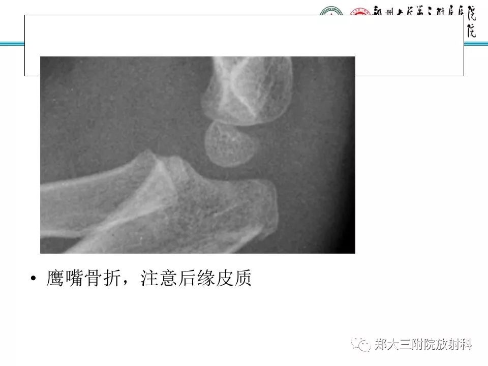 【PPT】儿童肘关节骨折的X线表现