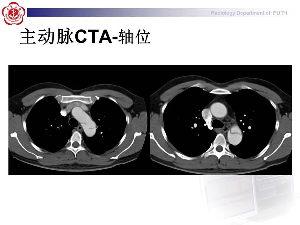 【PPT】主动脉夹层的影像