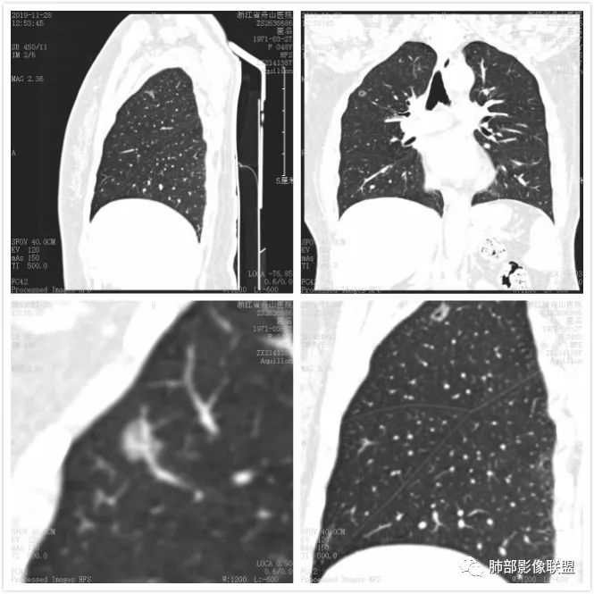 【病例】空泡和胸膜牵拉的价值你清楚吗? 【病例】空泡和胸膜牵拉的价值你清楚吗?