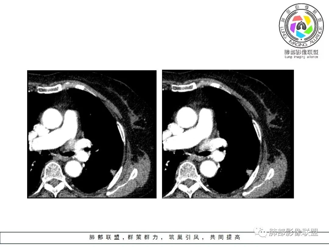 【病例】小征象大用途---脐凹征