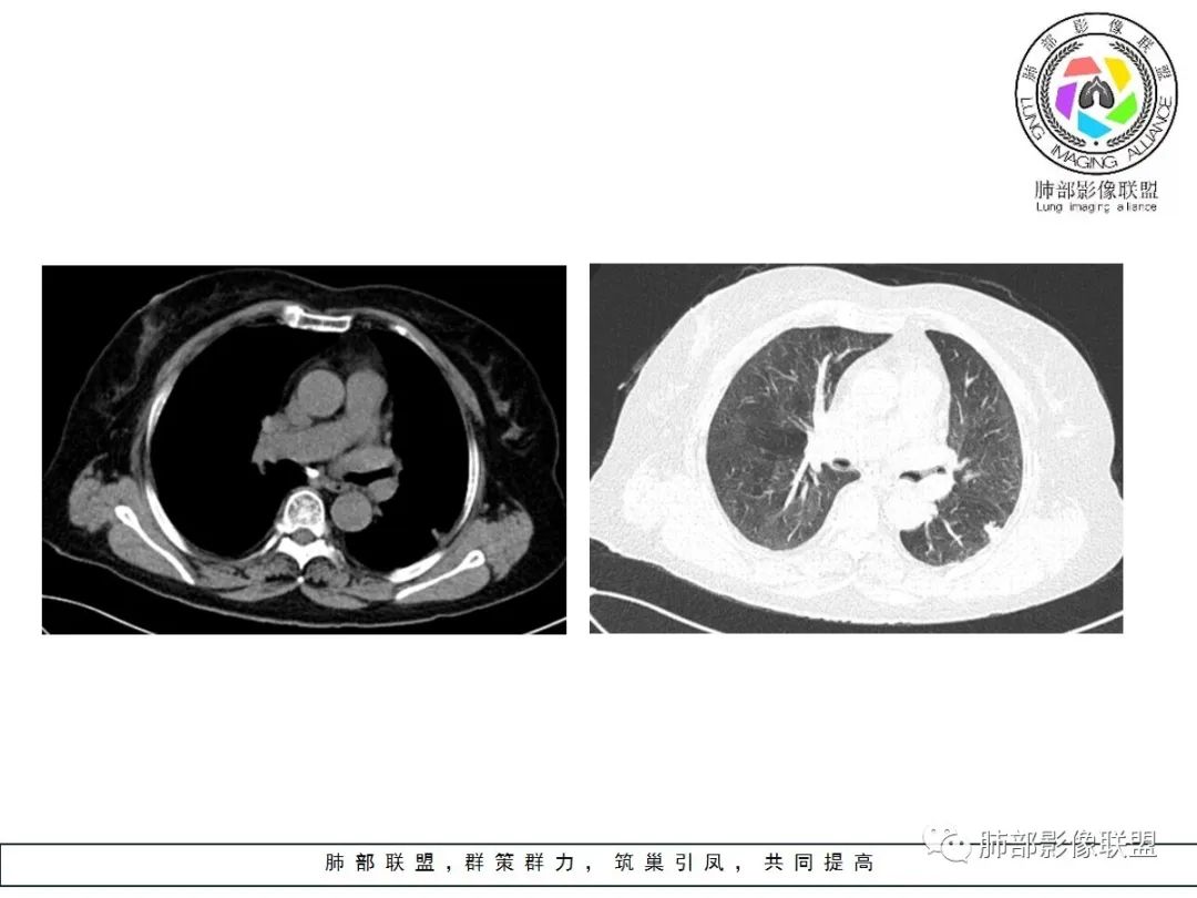 【病例】小征象大用途---脐凹征