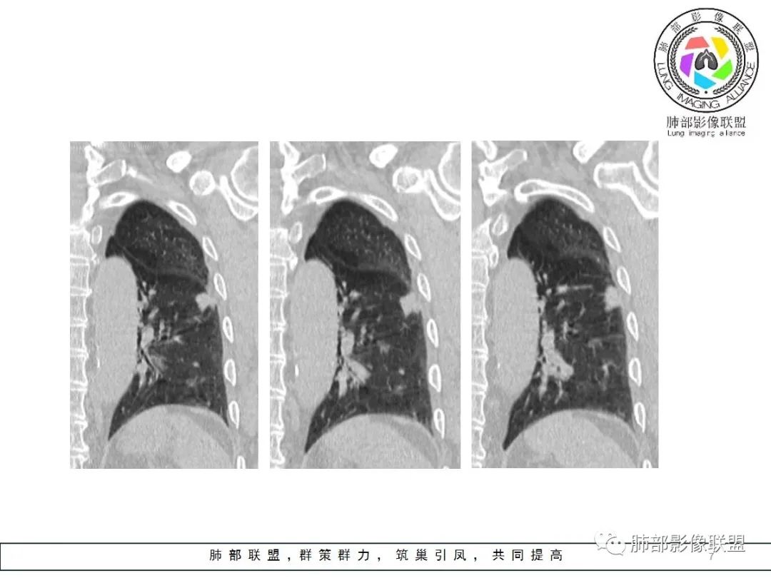 【病例】小征象大用途---脐凹征