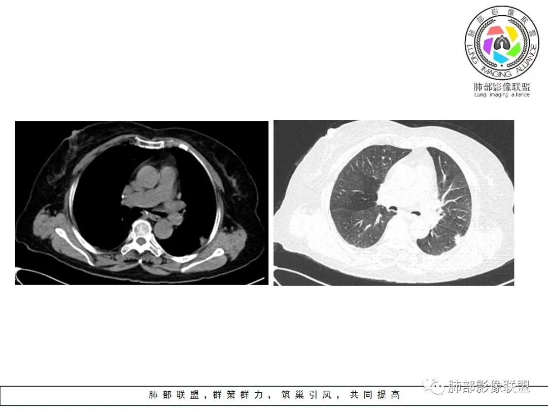【病例】小征象大用途---脐凹征
