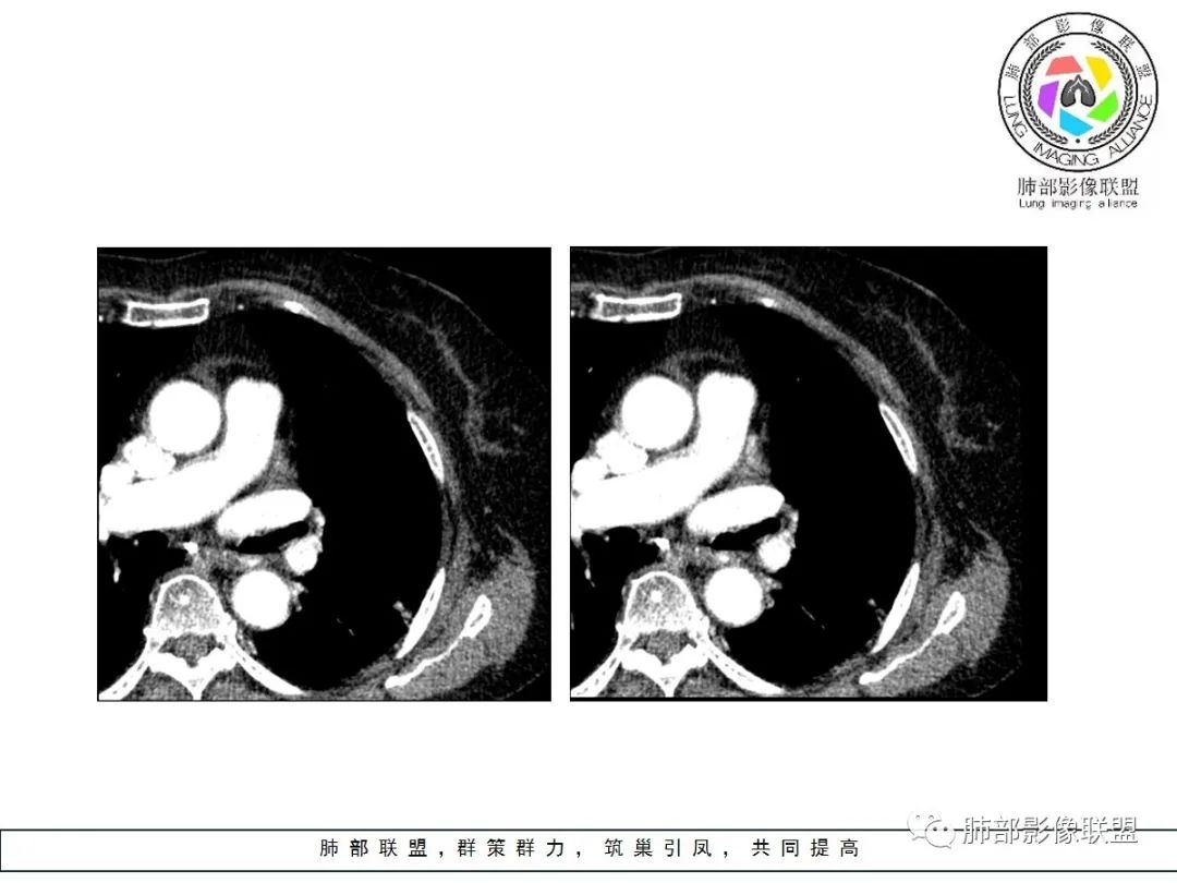 【病例】小征象大用途---脐凹征