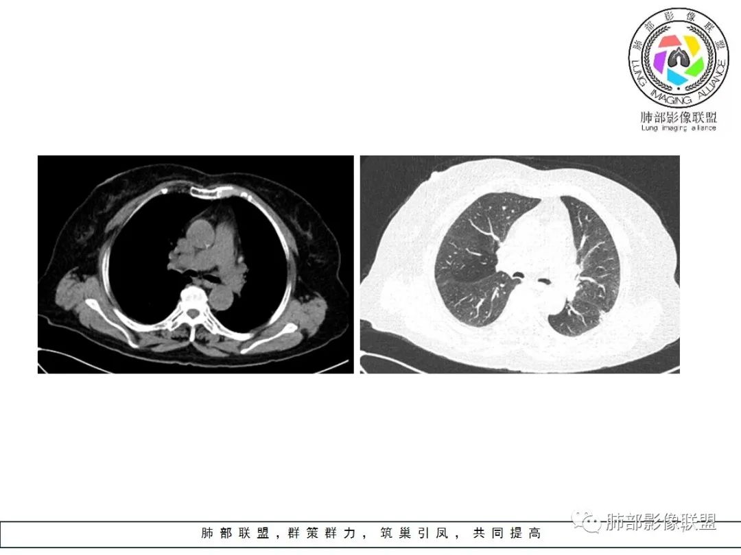 【病例】小征象大用途---脐凹征