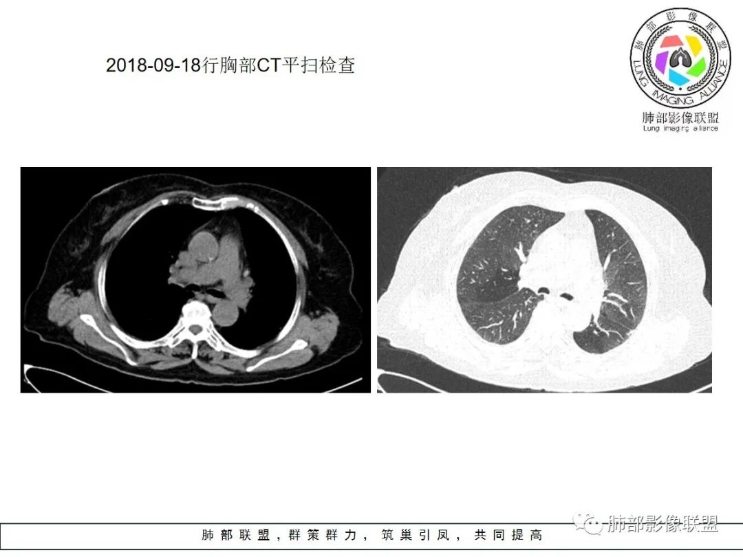 【病例】小征象大用途---脐凹征