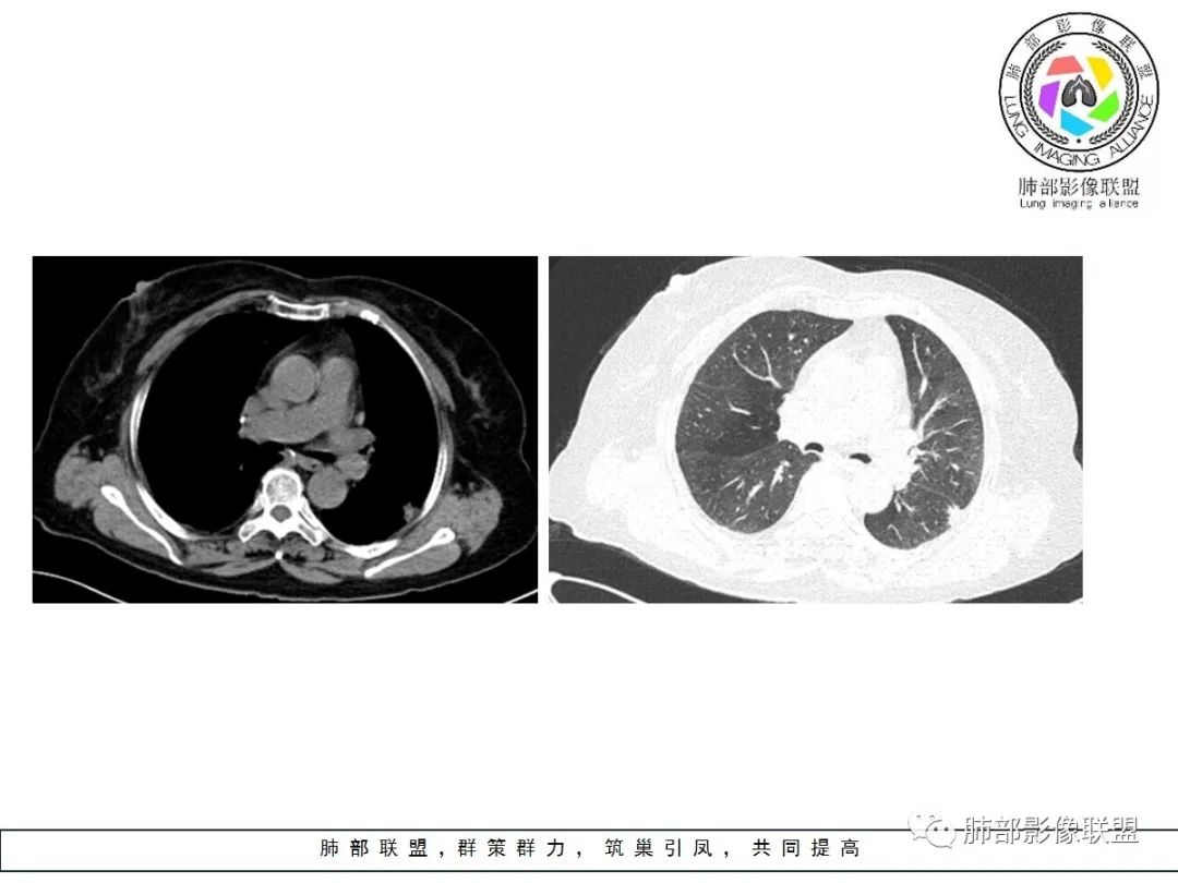【病例】小征象大用途---脐凹征