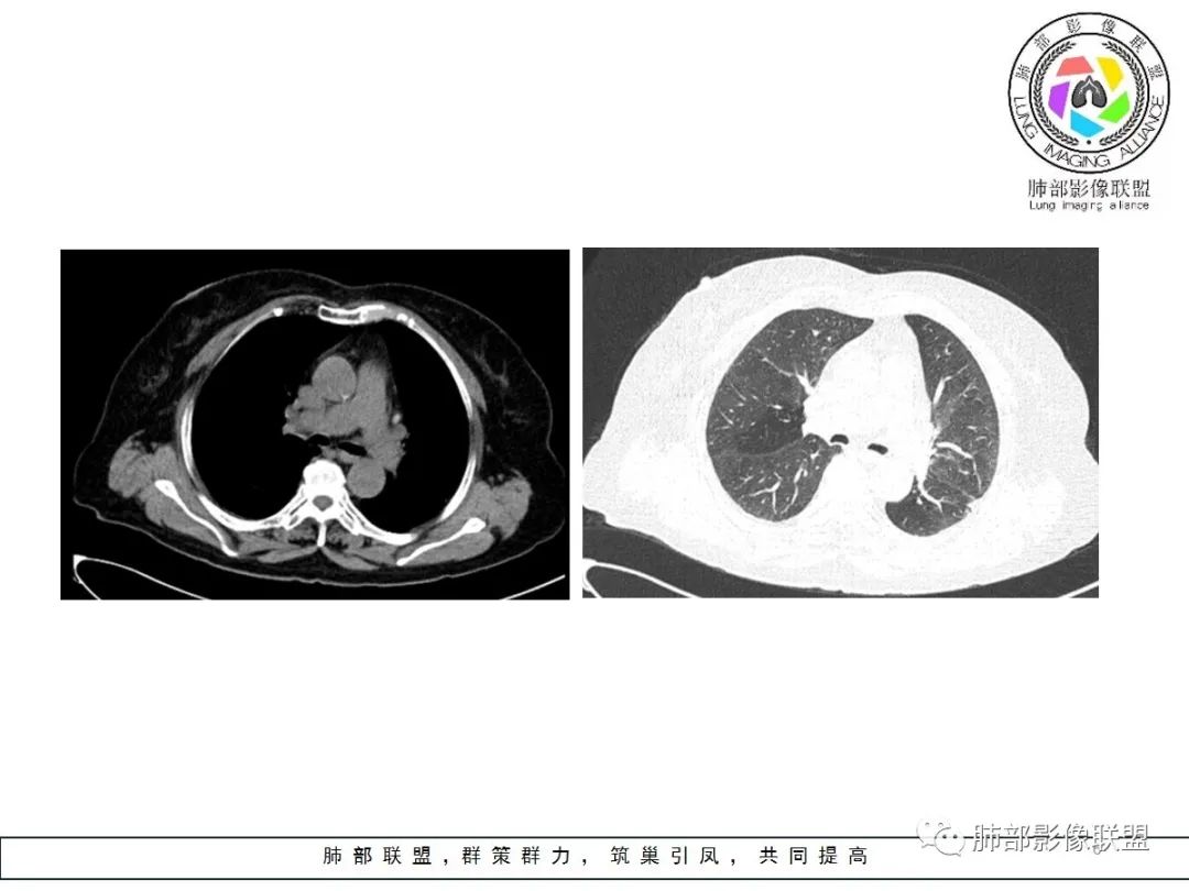 【病例】小征象大用途---脐凹征
