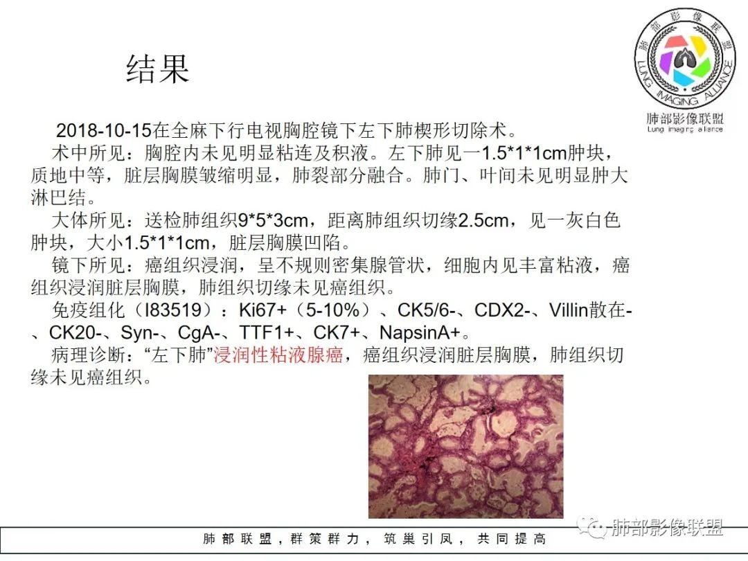【病例】小征象大用途---脐凹征