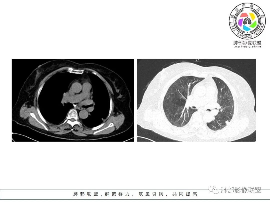 【病例】小征象大用途---脐凹征