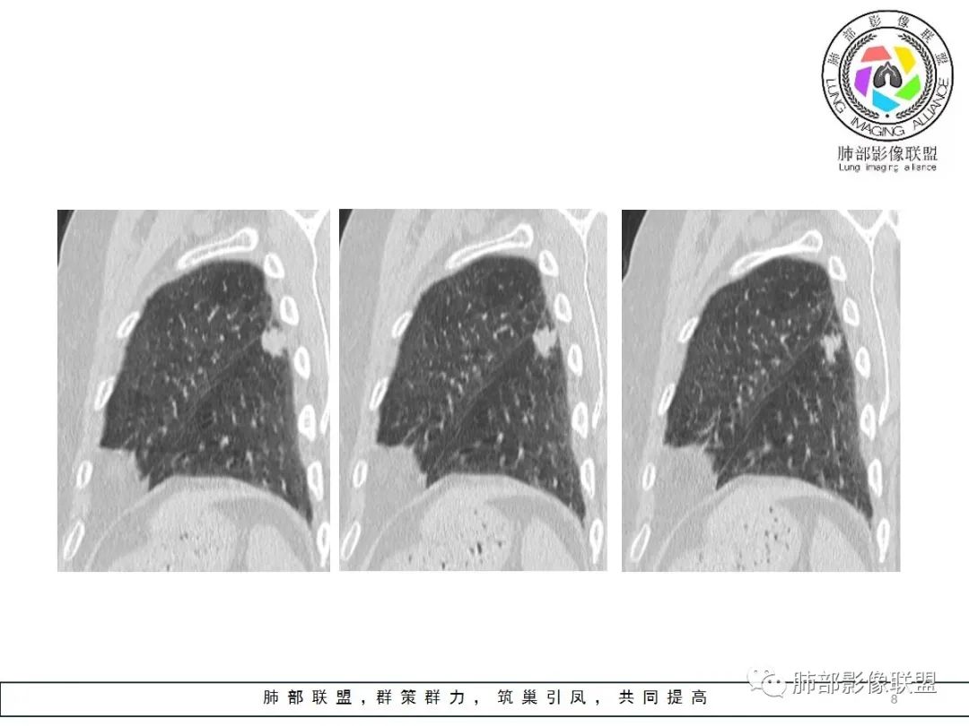 【病例】小征象大用途---脐凹征