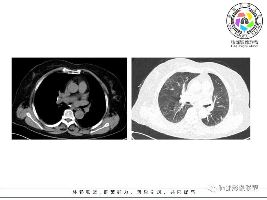 【病例】小征象大用途---脐凹征