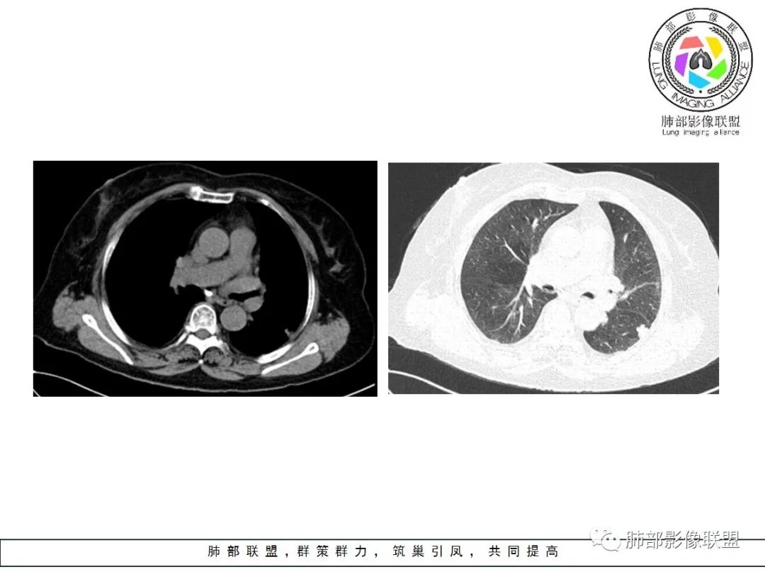 【病例】小征象大用途---脐凹征