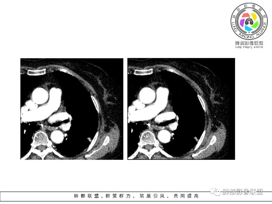 【病例】小征象大用途---脐凹征