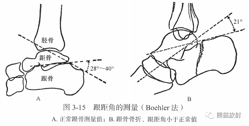 骨关节画线及测量