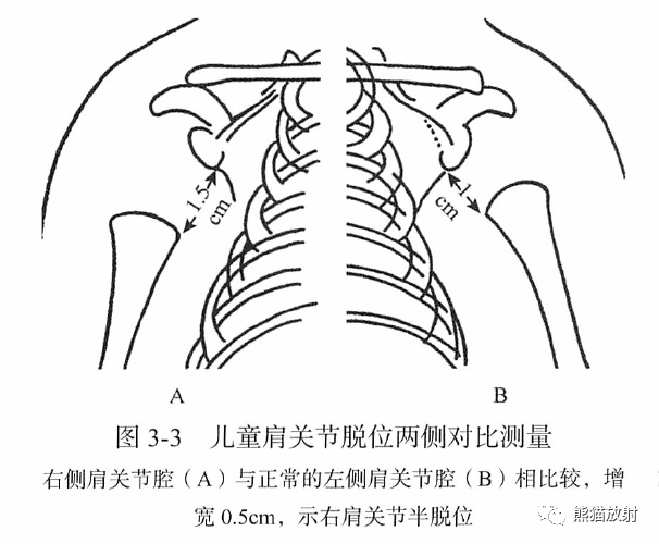 骨关节画线及测量