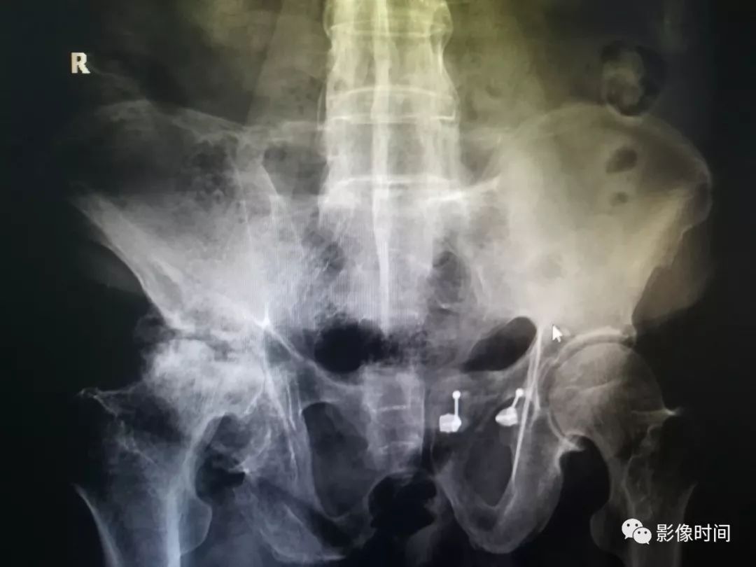 强直性脊柱炎的影像 强直性脊柱炎的影像