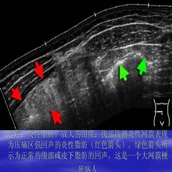 【PPT】急腹症影像诊断与鉴别诊断