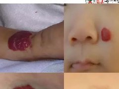 浅谈血管瘤和脉管畸形的临床和MRI检查
