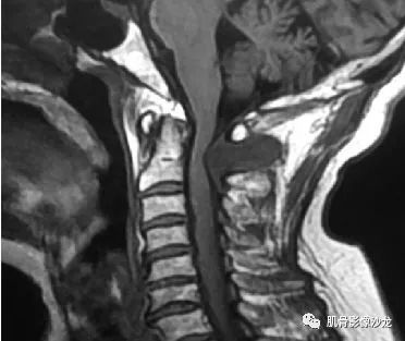 【病例】颈椎结节性筋膜炎1例CT及MR影像