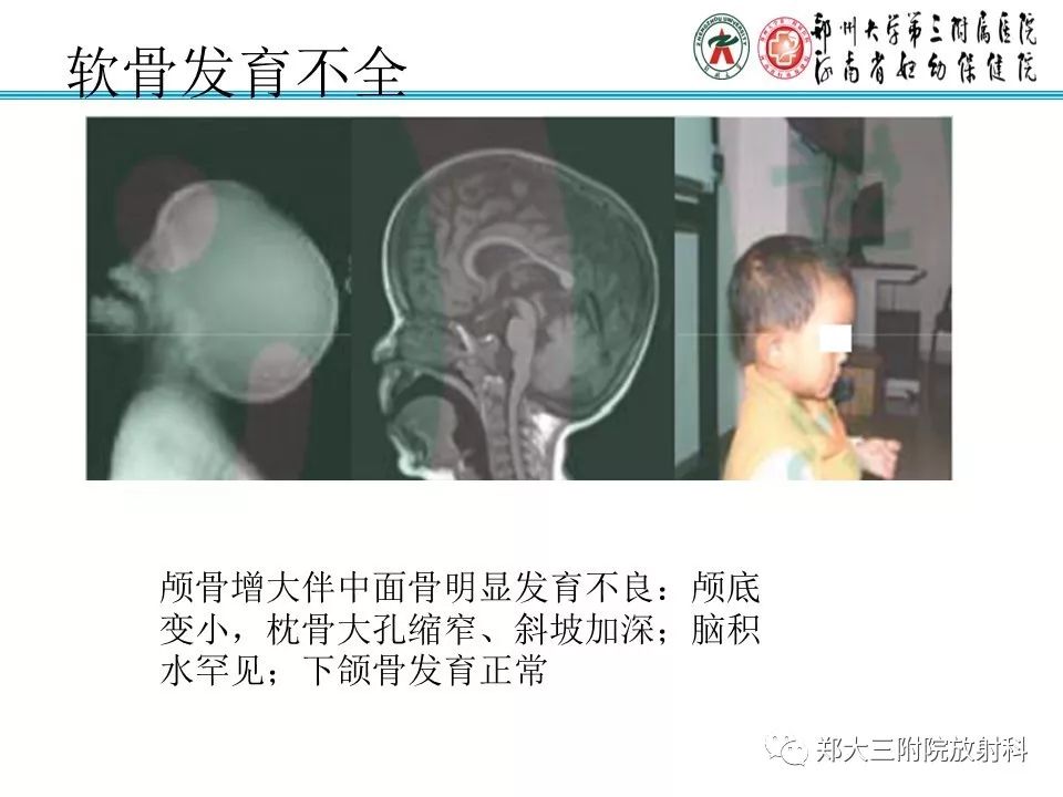 【PPT】儿童先天性骨软骨发育障碍性疾病影像诊断