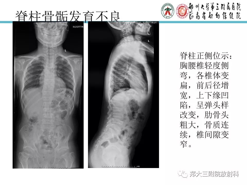 【PPT】儿童先天性骨软骨发育障碍性疾病影像诊断