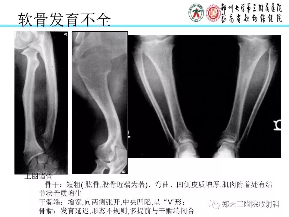 【PPT】儿童先天性骨软骨发育障碍性疾病影像诊断